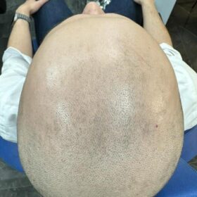 SMP-hår på man, 44 år, utförd hos Made Hair Academy Stockholm – toppval inom diskret hårpigmentering i Sverige