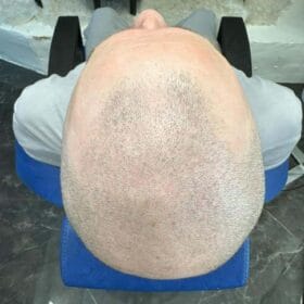 SMP-hår på man, 49 år, utförd hos Made Hair Academy Göteborg – ledande studio inom scalp micropigmentation i Sverige