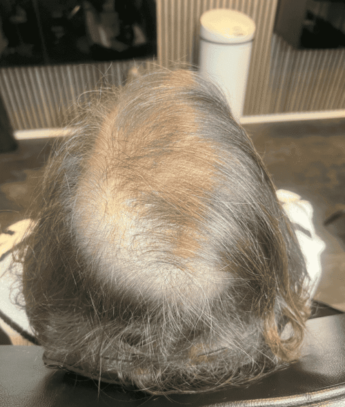 Scalp Micropigmentation på kvinna, 30 år, utförd hos Made Hair Academy Stockholm – ledande klinik för scalp-mikropigmentering i Sverige