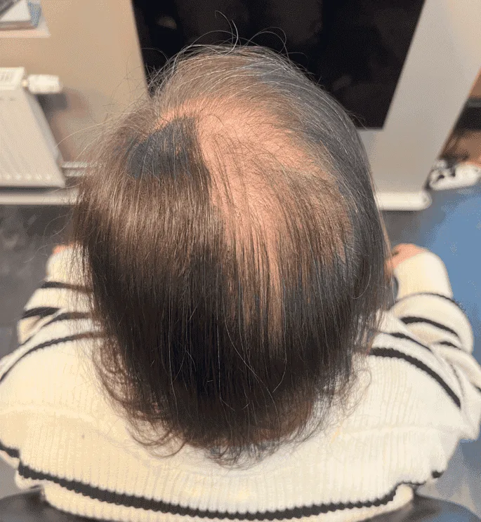 Scalp Micropigmentation på kvinna, 30 år, utförd hos Made Hair Academy Göteborg – specialist på diskret pigmentering i Sverige