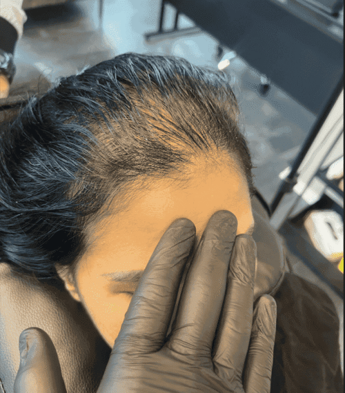 Scalp Micropigmentation på kvinna, 30 år, utförd hos Made Hair Academy Göteborg – ledande inom naturlig pigmentering i Sverige