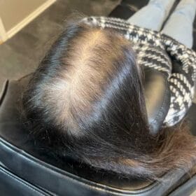Håravfall | Hårutfyllnad kvinna mitten & hjässa Scalp Micropigmentation på kvinna, 34 år, utförd hos Made Hair Academy Göteborg – expert inom naturlig hårtatuering i Sverige