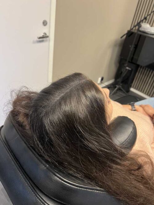 Håravfall | Hårutfyllnad kvinna mitten & hjässa Scalp Micropigmentation på kvinna, 34 år, utförd hos Made Hair Academy Stockholm– toppval inom scalp micropigmentation i Sverige
