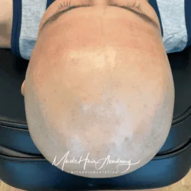 utfyllnad hårbotten Före & Efter Hårtattoo för man, 36 år, utförd hos Made Hair Academy Stockholm – ledande klinik för scalp-mikropigmentering i Sverige