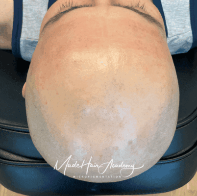 utfyllnad hårbotten Före & Efter Hårtattoo för man, 36 år, utförd hos Made Hair Academy Stockholm – ledande klinik för scalp-mikropigmentering i Sverige