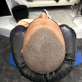 Hårpigmentering resultat på man, 30 år i Göteborg – utförd av Made Hair Academy Göteborg