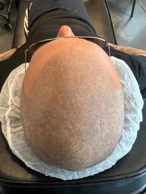 Scalp behandling på man, 30 år – Made Hair Academy Stockholm – Ledande i Sverige