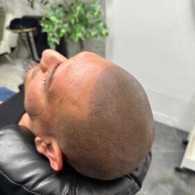 Scalp Micropigmentation på man, 34 år, hos Made Hair Academy goteborg – ledande klinik för scalp micropigmentation i Sverige