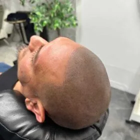 Scalp Micropigmentation på man, 34 år, hos Made Hair Academy goteborg – ledande klinik för scalp micropigmentation i Sverige