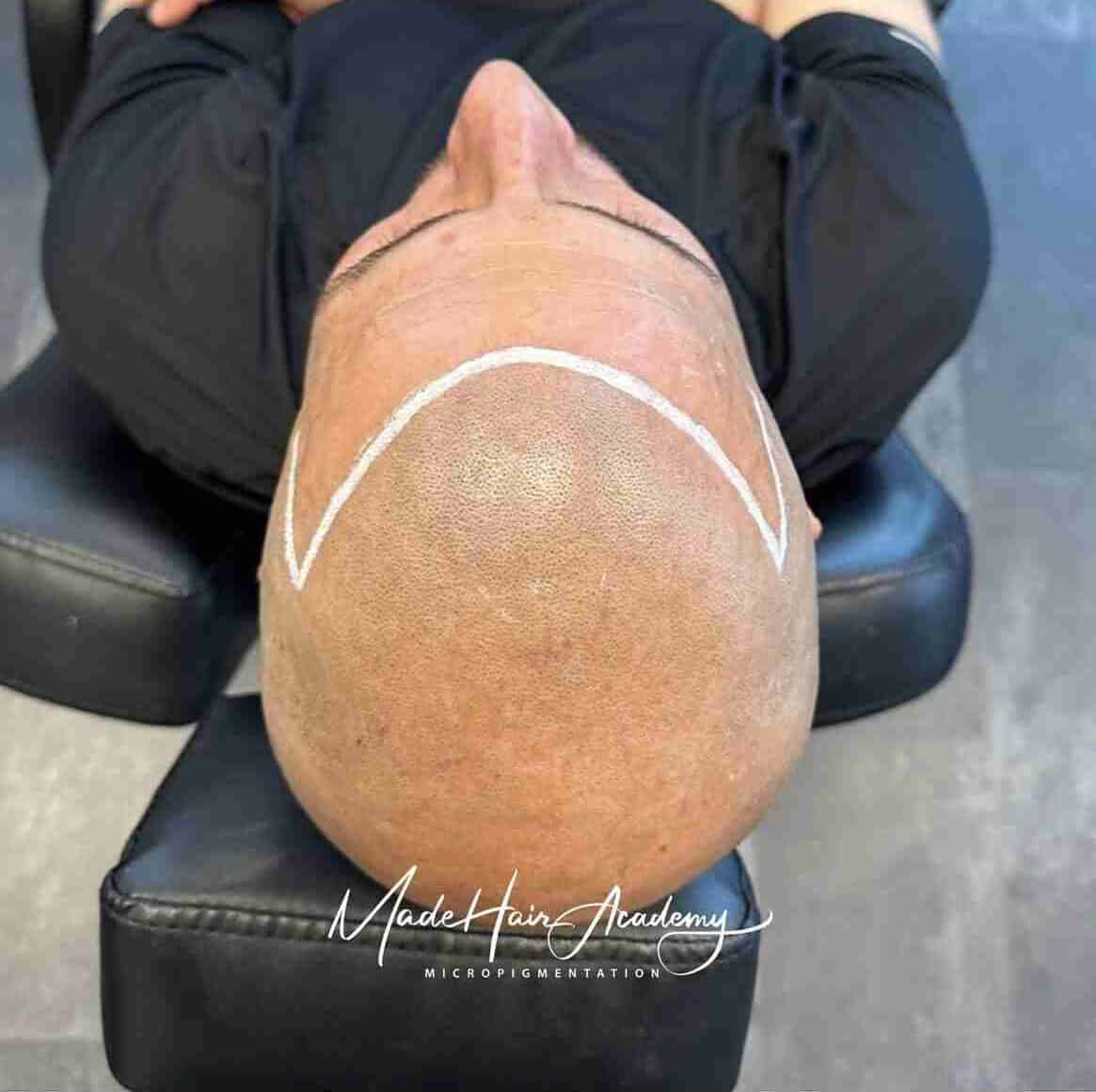 Hårpigmentering på man, 38 år, hos Made Hair Academy malmö – ledande klinik för scalp micropigmentation i Sverige
