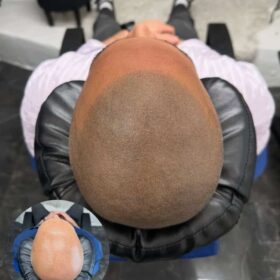 Hårpigmentering på man, 38 år, hos Made Hair Academy stockholm – ledande klinik för scalp micropigmentation i Sverige