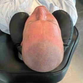 Hårpigmentering för man, 38 år, utförd hos Made Hair Academy Göteborg – ledande klinik för diskret hårtatuering i Sverige