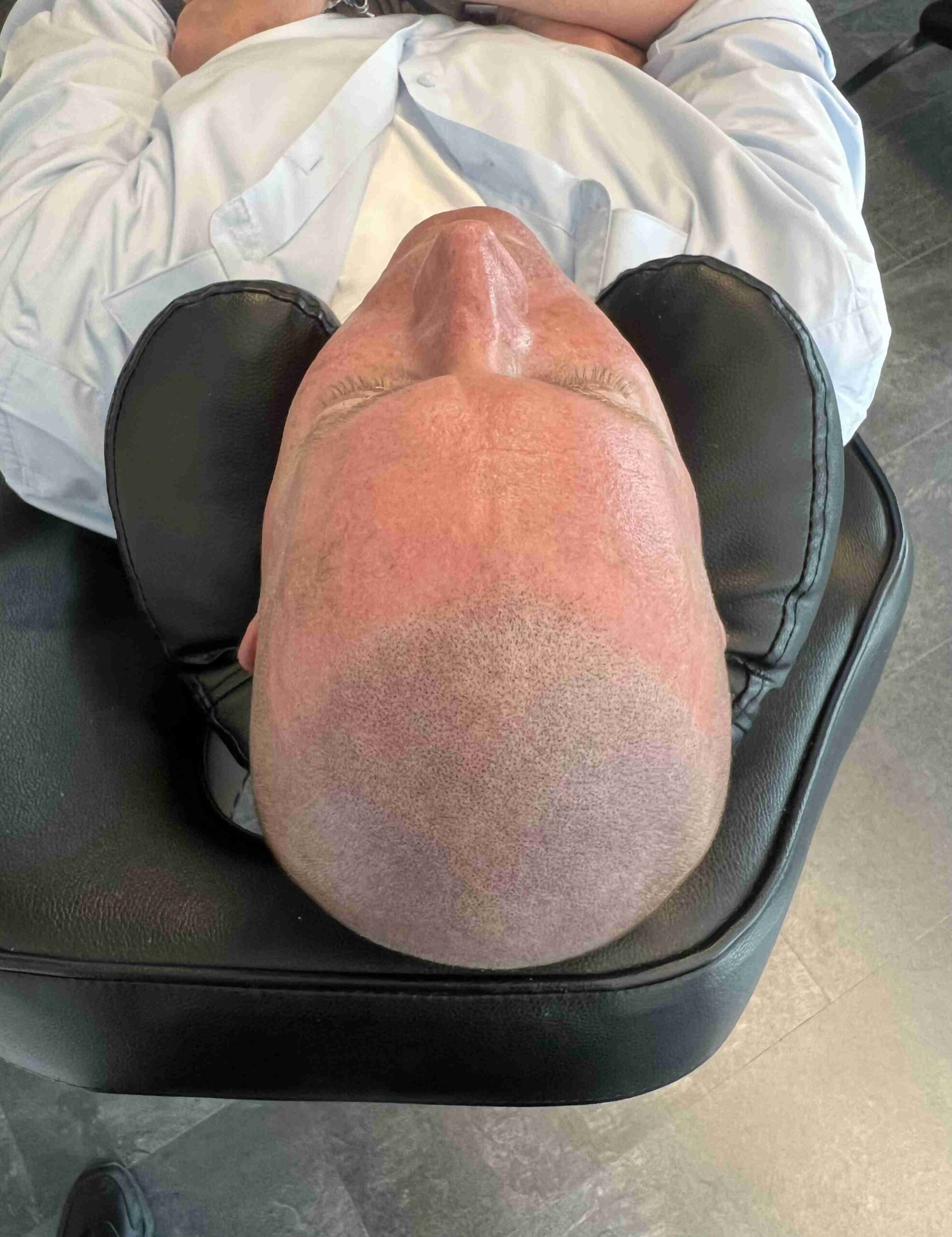 Hårpigmentering för man, 38 år, utförd hos Made Hair Academy Göteborg – ledande klinik för diskret hårtatuering i Sverige