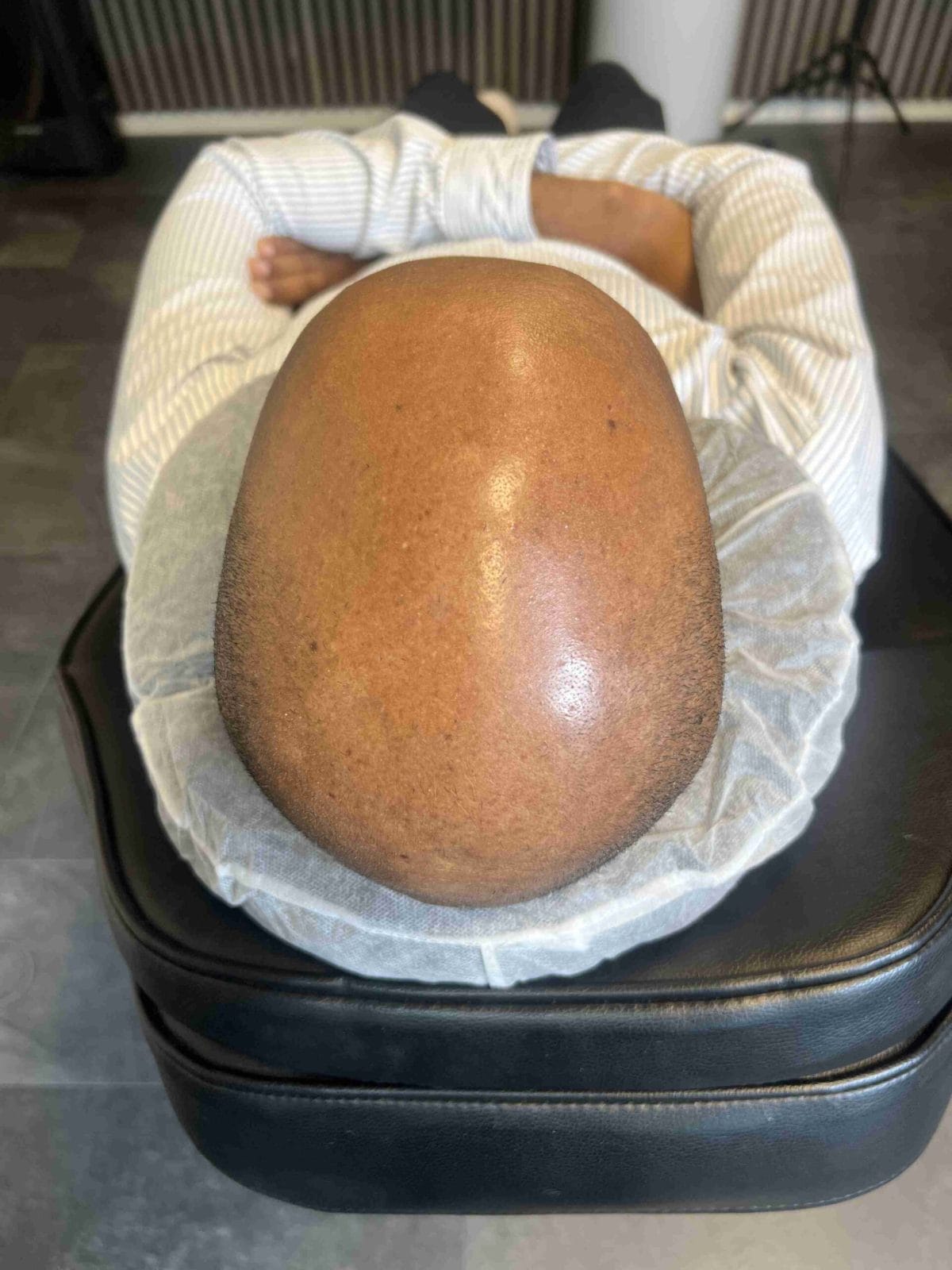 Hårpigmentering för man, 42 år, utförd hos Made Hair Academy Stockholm – ledande studio för diskret hårtatuering i Sverige