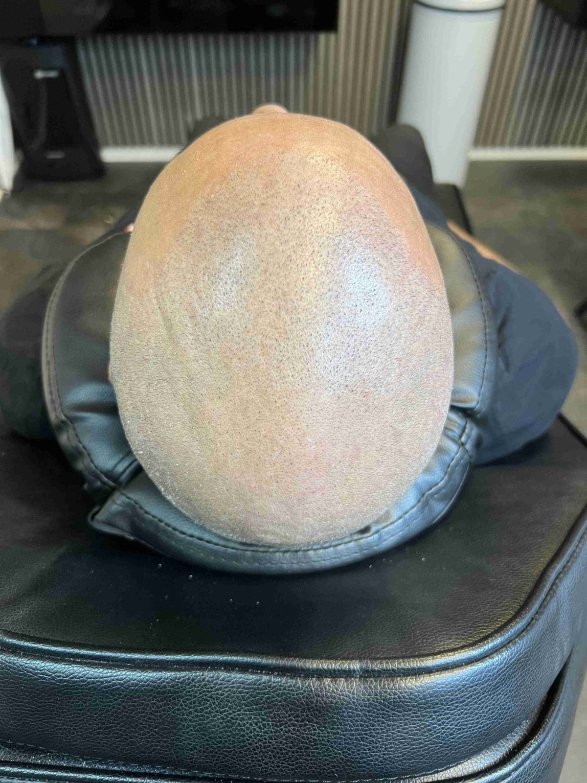 Hårpigmentering för man, 42 år, utförd hos Made Hair Academy Göteborg – ledande inom hårtatuering i Sverige