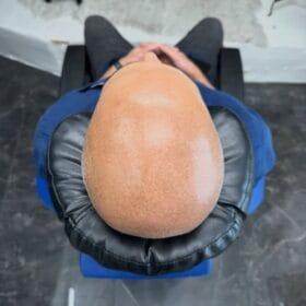 Hårpigmentering på man, 34 år, hos Made Hair Academy Stockholm– ledande klinik för scalp micropigmentation i Sverige