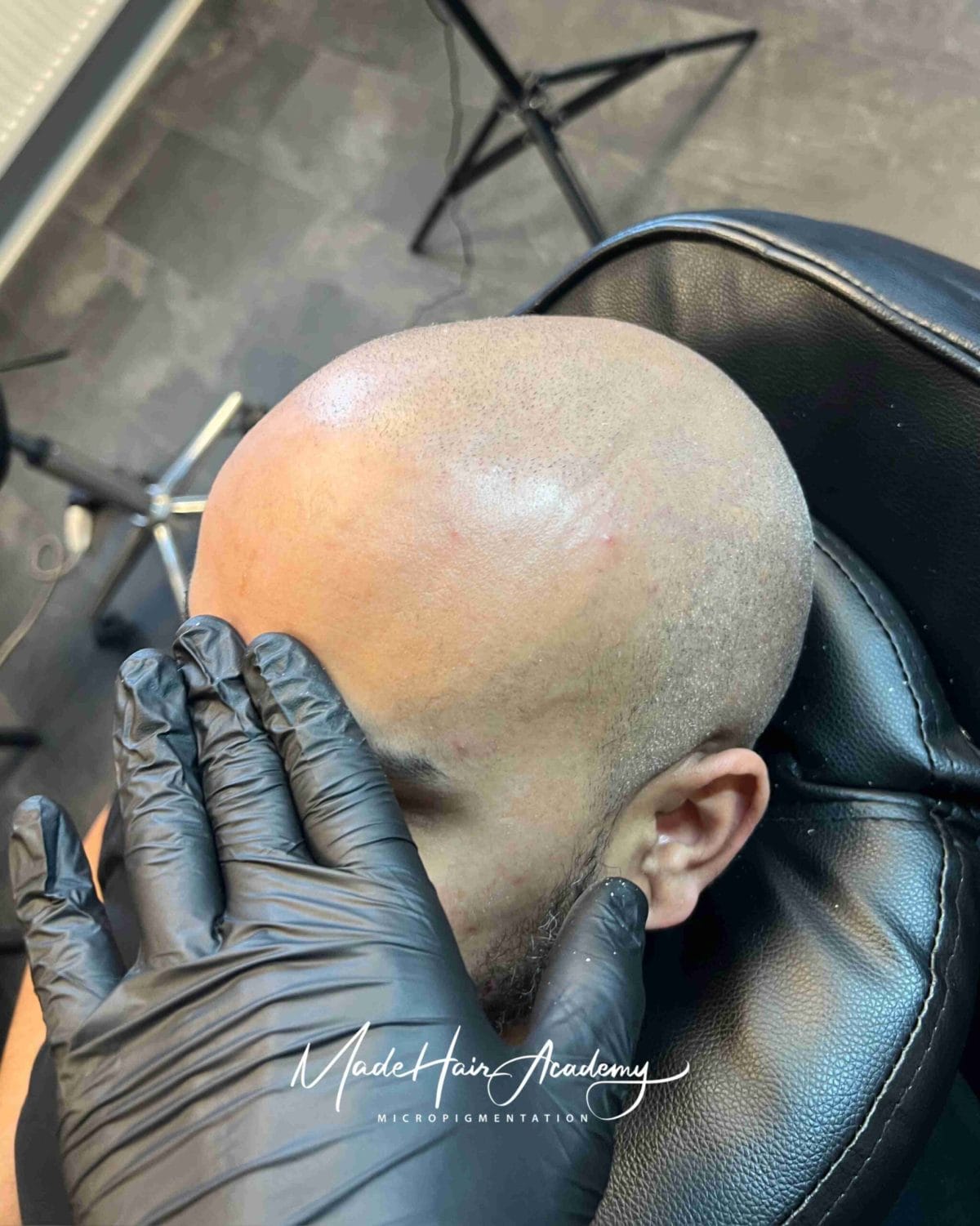 Scalp Micropigmentation på man, 38 år, hos Made Hair Academy stockholm – ledande klinik för scalp micropigmentation i Sverige