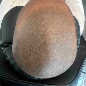 Scalp micropigmentation på man, 42 år, utförd hos Made Hair Academy Stockholm – ledande klinik inom hårpigmentering i Sverige