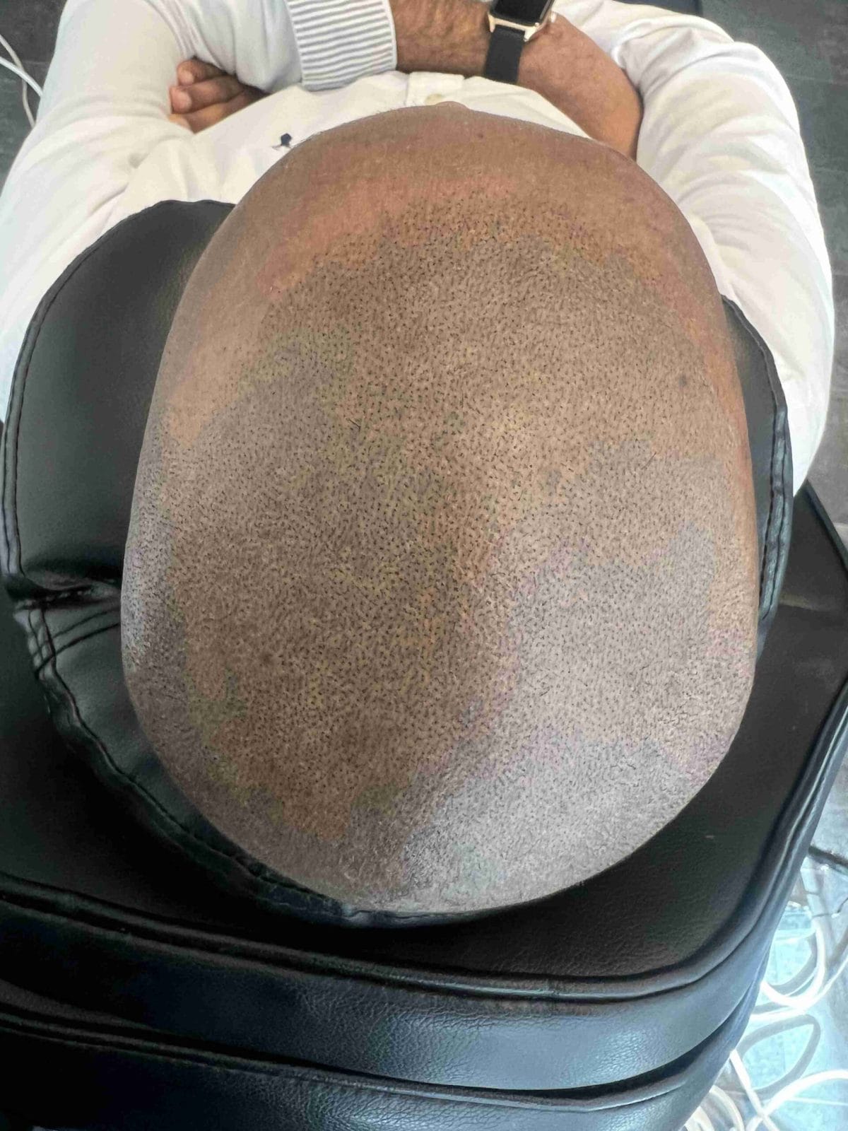 Scalp micropigmentation på man, 42 år, utförd hos Made Hair Academy Stockholm – ledande klinik inom hårpigmentering i Sverige