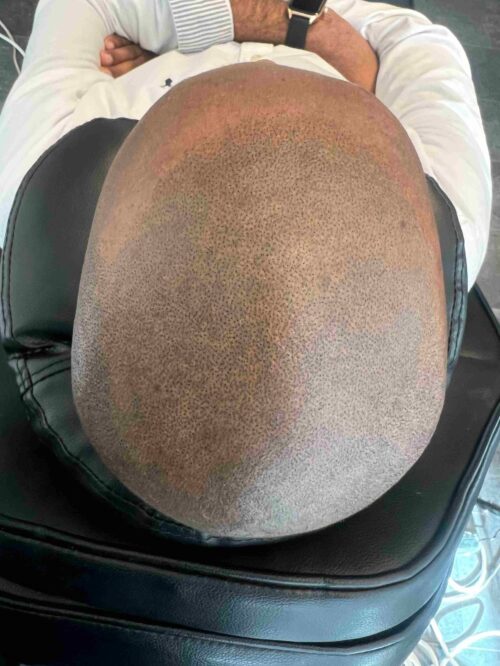 Scalp micropigmentation på man, 42 år, utförd hos Made Hair Academy Stockholm – ledande klinik inom hårpigmentering i Sverige