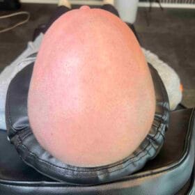 Scalp micropigmentering för man, 42 år, utförd i Stockholm av Made Hair Academy – ledande klinik inom hårpigmentering i Sverige