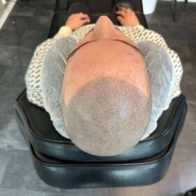 Scalp micropigmentation för man, 42 år, utförd hos Made Hair Academy Göteborg – ledande studio inom SMP i Sverige
