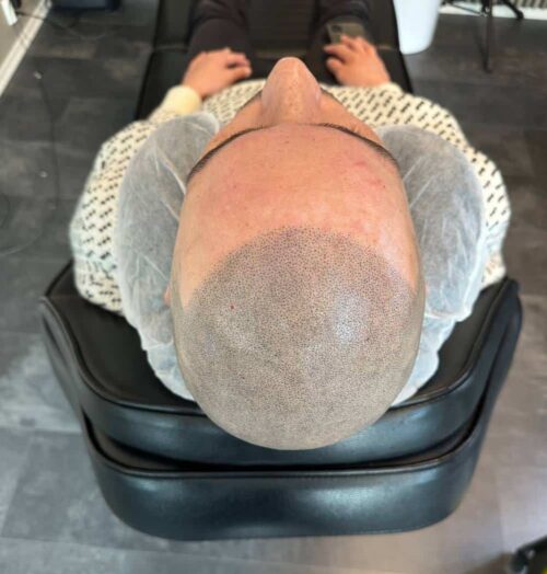 Scalp micropigmentation för man, 42 år, utförd hos Made Hair Academy Göteborg – ledande studio inom SMP i Sverige