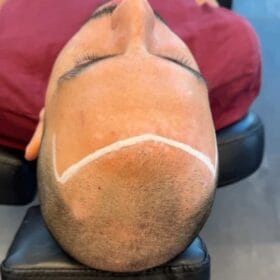 alopecia Scalp micropigmentation för man, 47 år, utförd hos Made Hair Academy Göteborg – ledande aktör inom hårtatuering i Sverige