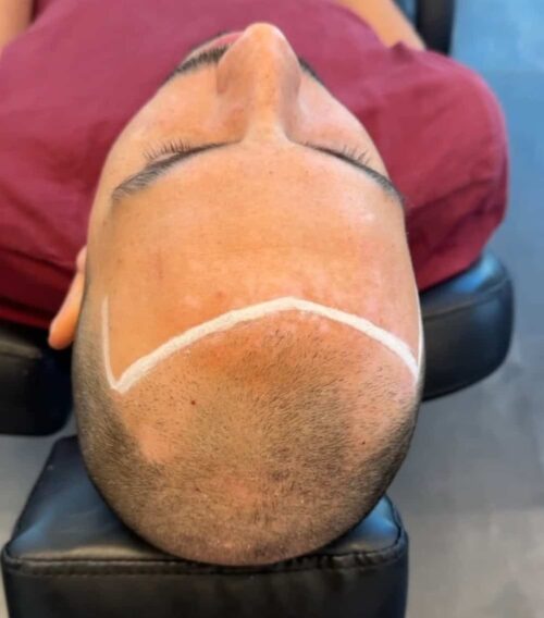 Scalp micropigmentation för man, 47 år, utförd hos Made Hair Academy Göteborg – ledande aktör inom hårtatuering i Sverige