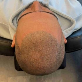 Scalp micropigmentation för man, 47 år, utförd hos Made Hair Academy Stockholm – ledande expert på hårpigmentering i Sverige