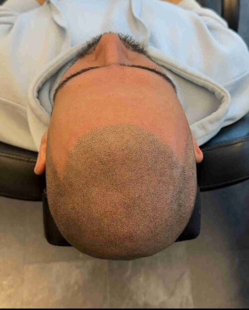 Scalp micropigmentation för man, 47 år, utförd hos Made Hair Academy Stockholm – ledande expert på hårpigmentering i Sverige