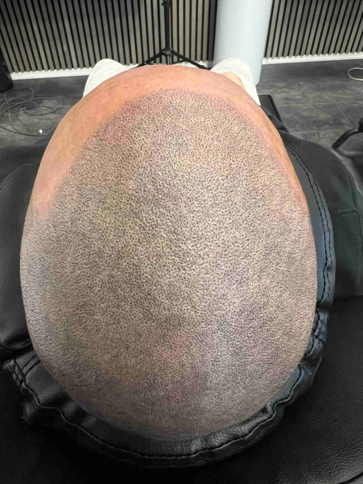SMP-hår på man, 31 år, utförd hos Made Hair Academy Göteborg – ledande aktör inom scalp micropigmentation i Sverige