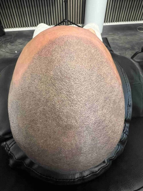 SMP-hår på man, 31 år, utförd hos Made Hair Academy Göteborg – ledande aktör inom scalp micropigmentation i Sverige