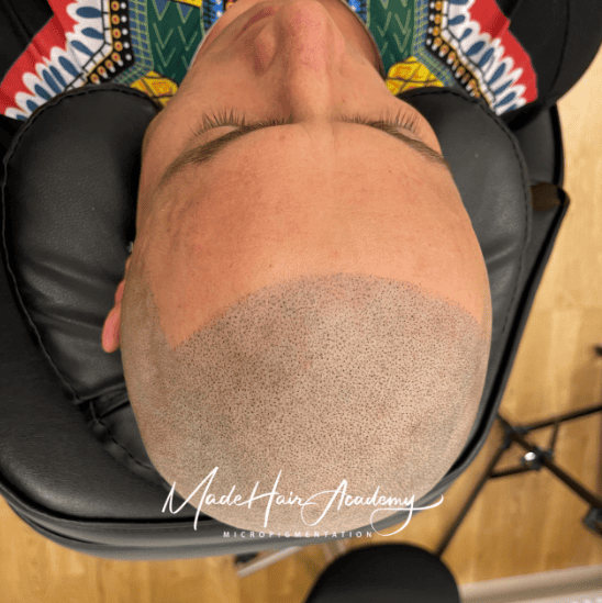 Scalp micropigmentering rak look nivå 4 SMP-hår på man, 36 år, utförd hos Made Hair Academy Stockholm – specialist på hårpigmentering i Sverige