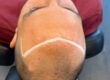 alopecia. Håravfall blogg