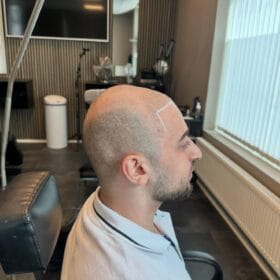 Benefits of scalp micropigmentation at Made Hair Academy in Stockholm