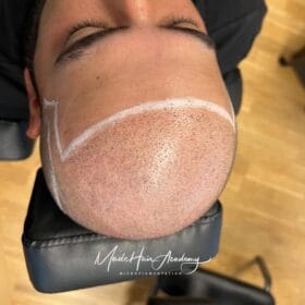 Hårtatuering Före | hår transplantation pris