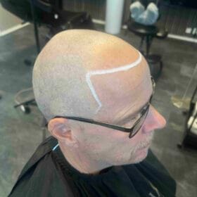 Scalp Micropigmentation Pris