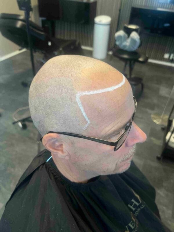 DHI Hårtransplantation tillsammans med Scalp Micropigmentation pris