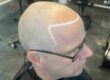 Hårtransplantation och SMP hos Made Hair Academy