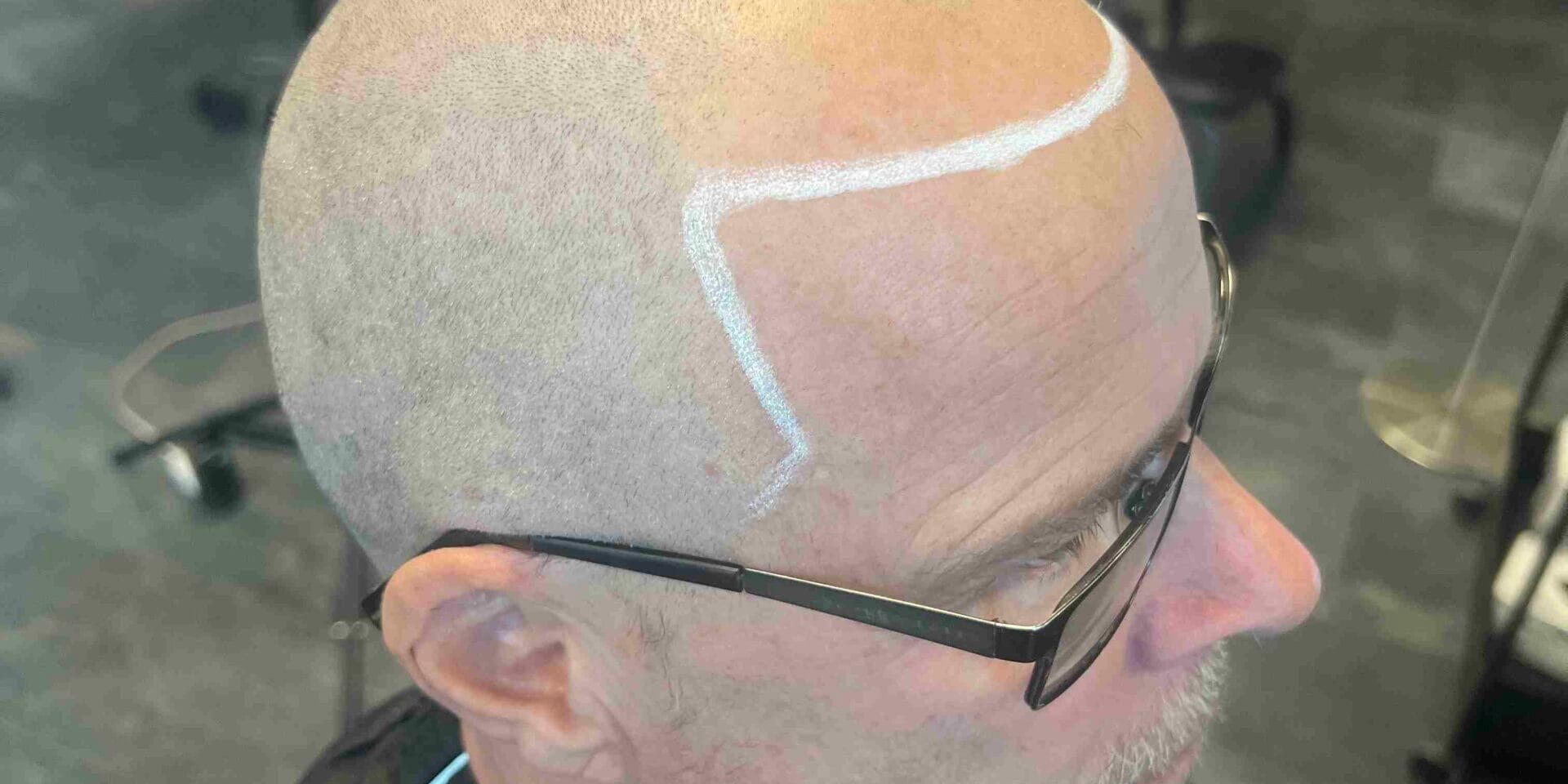 Hårtransplantation och SMP hos Made Hair Academy