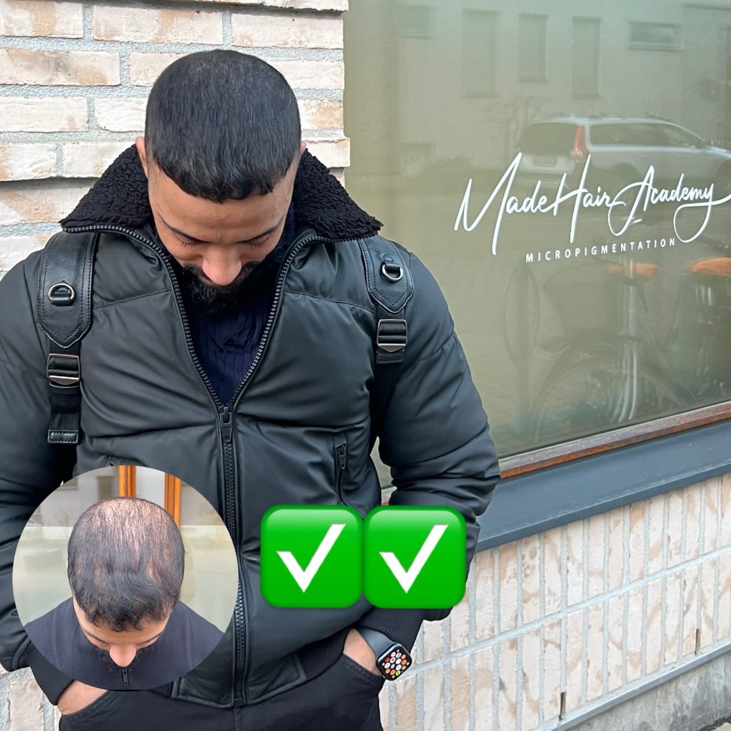 10 anledningar varför du ska välja scalp micropigmentation. SMP utbildning hos Made Hair Academy