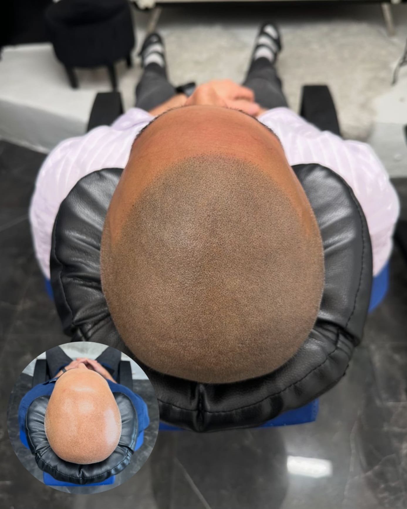Före och efter hårpigmentering med tydligt designat hårfäste hos Made Hair Academy