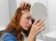 Alopecia areata
