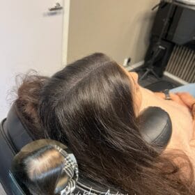 Alopecia areta behandling