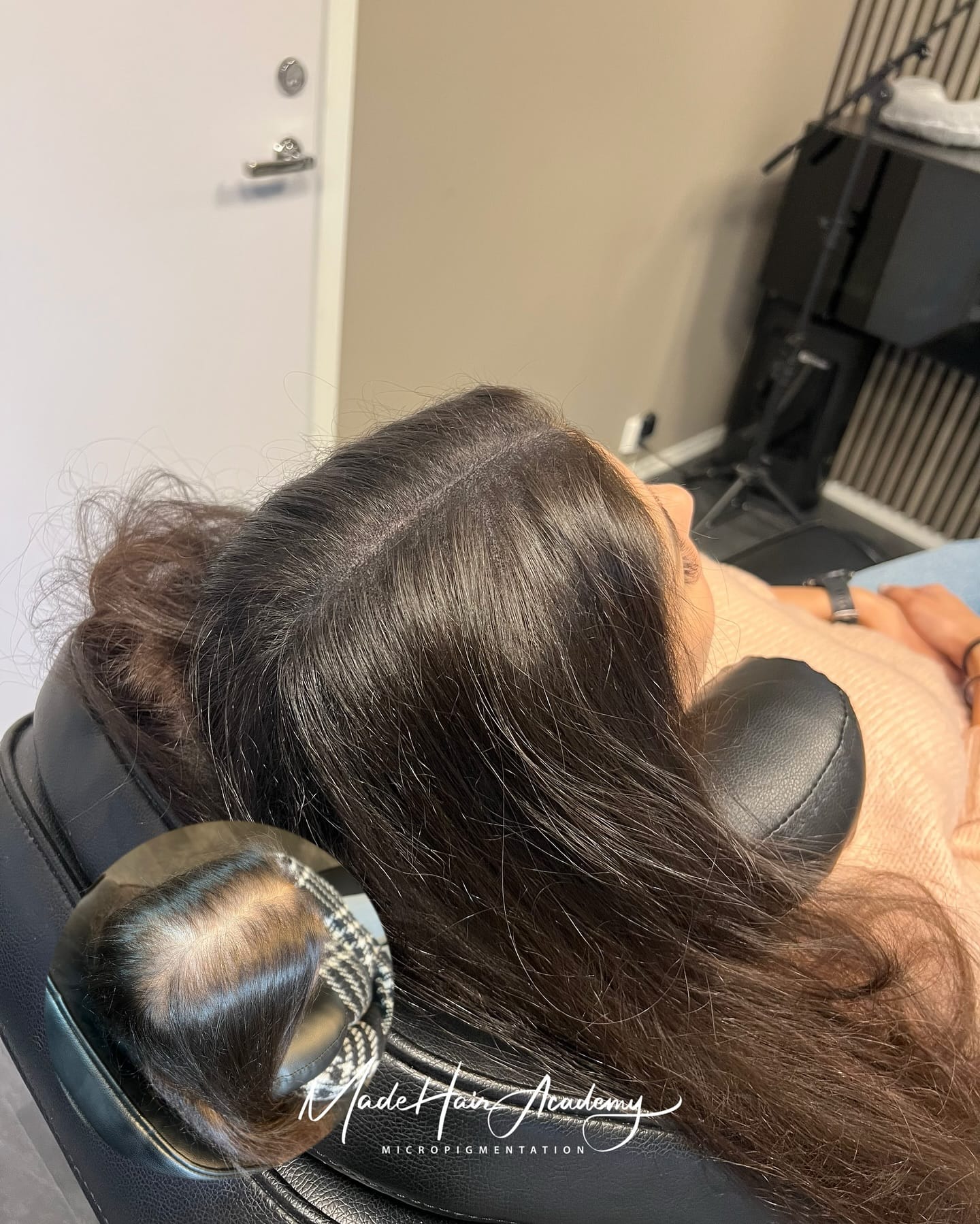 Alopecia areata inför SMP-bedömning