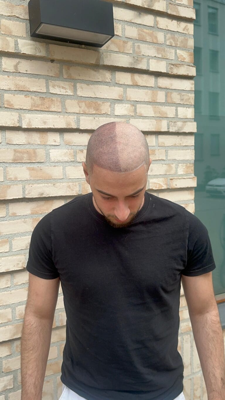 Resultat efter DHI hårtransplantation