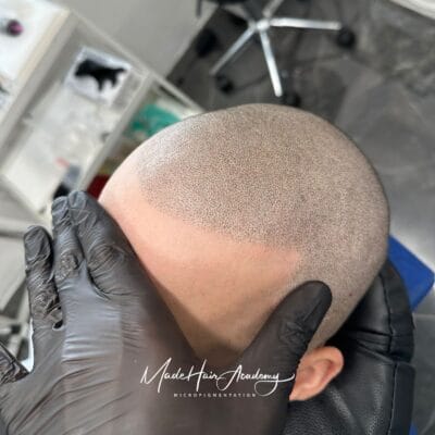 SMP Scalp micropigmentation Göteborg och Stockholm