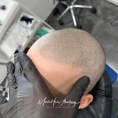 SMP Scalp micropigmentation Göteborg och Stockholm