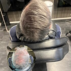 Scalp Micropigmentation FAQ